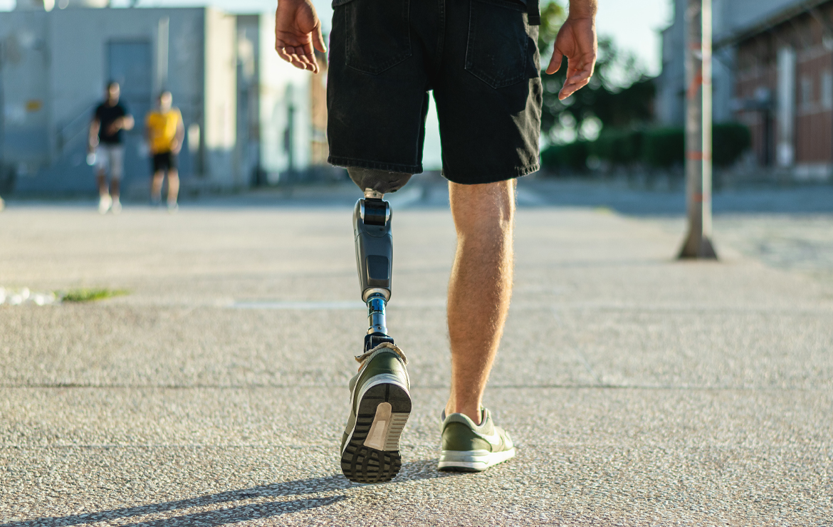 What you need to know about lower limb prostheses and factors that drive up costs